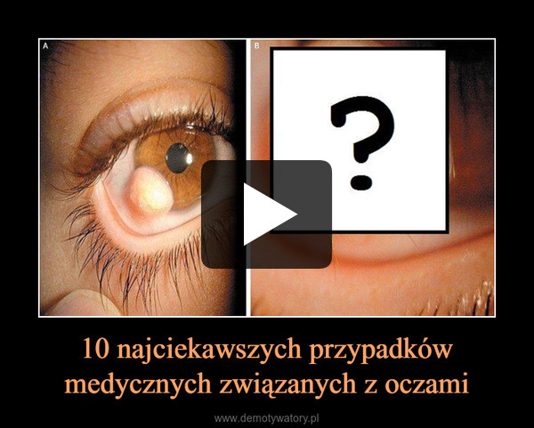 10 najciekawszych przypadków medycznych związanych z oczami –  