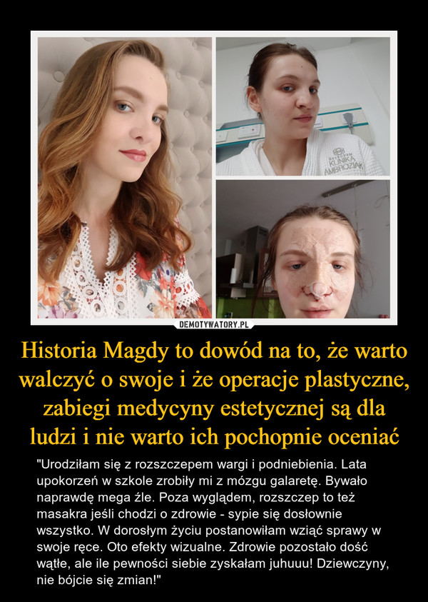 Historia Magdy to dowód na to, że warto walczyć o swoje i że operacje plastyczne, zabiegi medycyny estetycznej są dla ludzi i nie warto ich pochopnie oceniać – "Urodziłam się z rozszczepem wargi i podniebienia. Lata upokorzeń w szkole zrobiły mi z mózgu galaretę. Bywało naprawdę mega źle. Poza wyglądem, rozszczep to też masakra jeśli chodzi o zdrowie - sypie się dosłownie wszystko. W dorosłym życiu postanowiłam wziąć sprawy w swoje ręce. Oto efekty wizualne. Zdrowie pozostało dość wątłe, ale ile pewności siebie zyskałam juhuuu! Dziewczyny, nie bójcie się zmian!" 