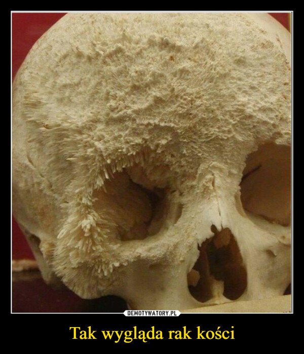 Tak wygląda rak kości –  